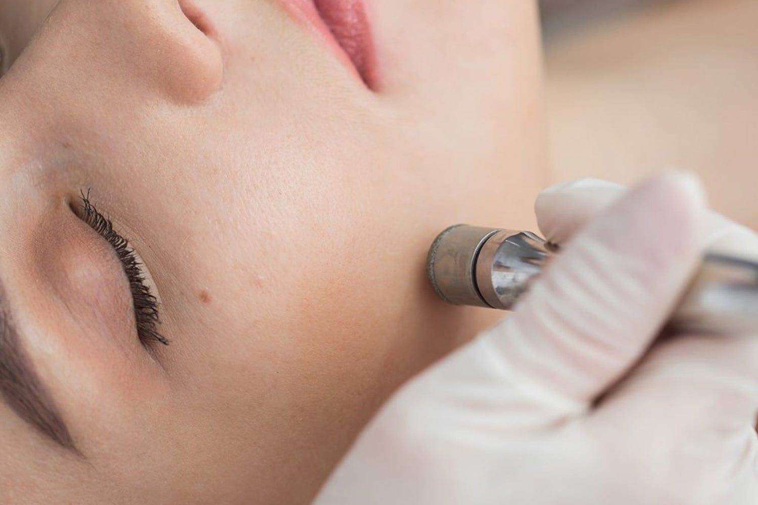 Sublimez votre peau avec la Microdermabrasion
